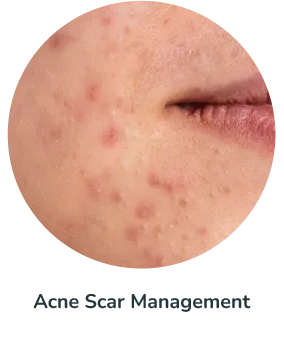 Acne Scar Management