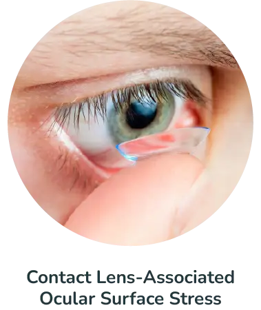 Contact Lens-Associated Ocular Surface Stress