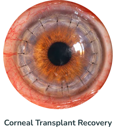 Corneal Transplant Recovery@4x