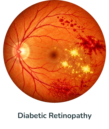 Diabetic Retinopathy@4x
