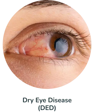 Dry Eye Disease