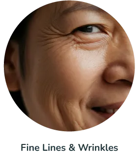 Fine Lines & Wrinkles
