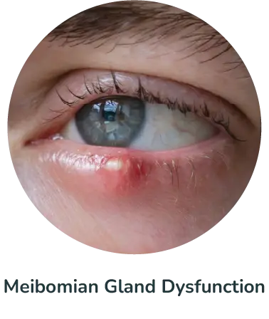 Meibomian Gland Dysfunction