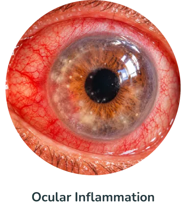 Ocular Inflammation@4x
