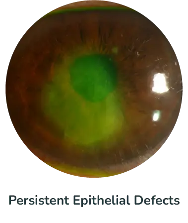 Persistent Epithelial Defects