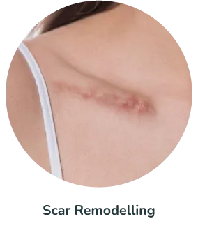 Scar Remodelling